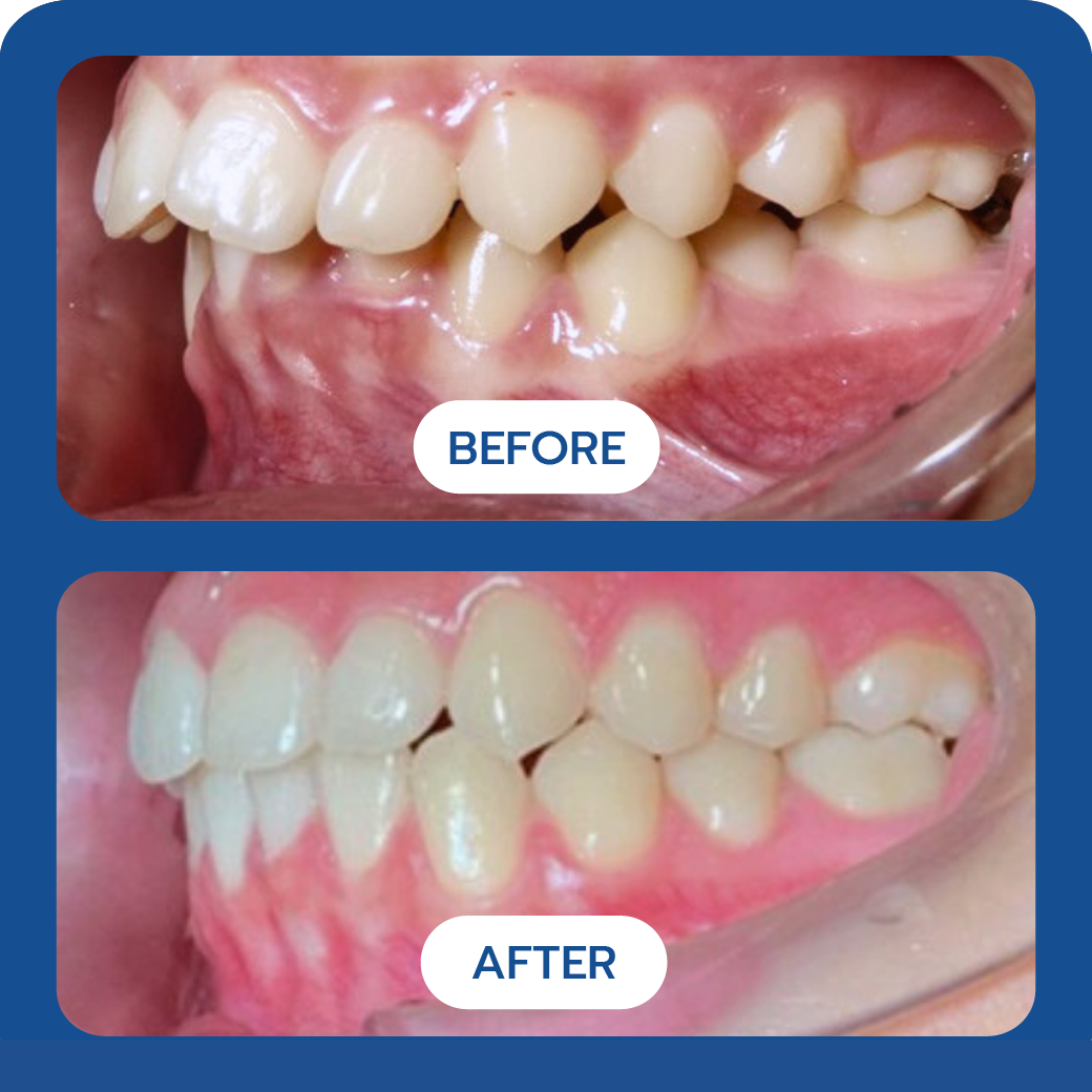 Invisalign Before and After Case 3